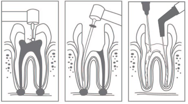Load image into Gallery viewer, Endodontic Aspirator Tips (20pcs/box) - Cotisen  **  OFFER  50% OFF **
