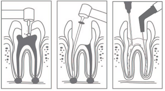 Endodontic Aspirator Tips (20pcs/box) - Cotisen  **  OFFER  50% OFF **