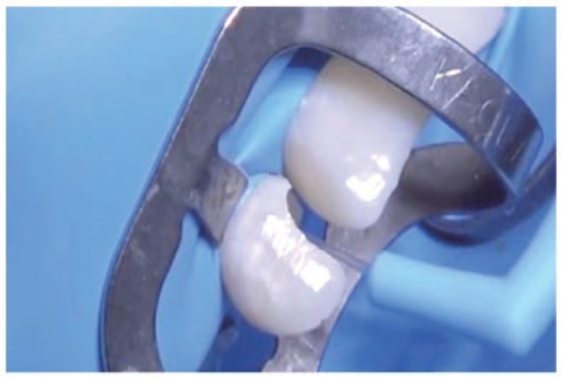 Load image into Gallery viewer, Endodontic Aspirator Tips (20pcs/box) - Cotisen  **  OFFER  50% OFF **
